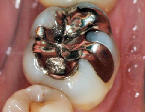 インレー施術前