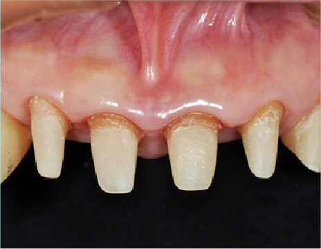 ジルコニアクラウン（前歯）施術前