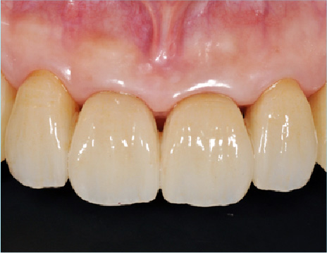 ジルコニアクラウン（前歯）施術後