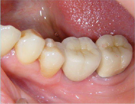 ルコニアインレー・クラウン（臼歯）施術後