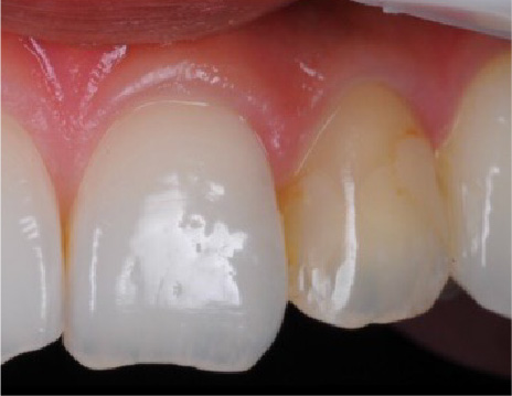 ジルコニアクラウン（前歯）施術前